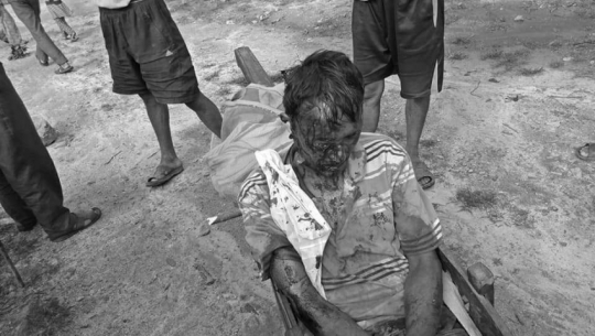 भालुको आक्रमणबाट घाईते भएका डोटीका एक जना नेपालगञ्ज रेफर