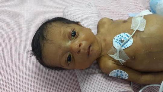 बैतडीका शिवांशको उपचारका लागि जापानबाट सहयोग