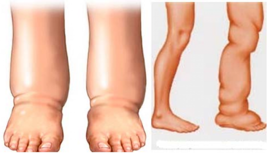 कैलालीमा आजदेखि हात्तीपाइलेको औषधी खुवाइँदै