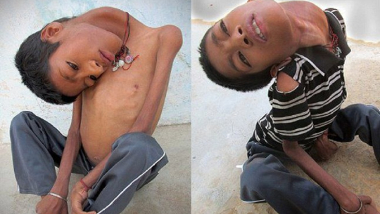 यी व्यक्तिको गर्दन जुन १८० डिग्रीमा घुम्छ