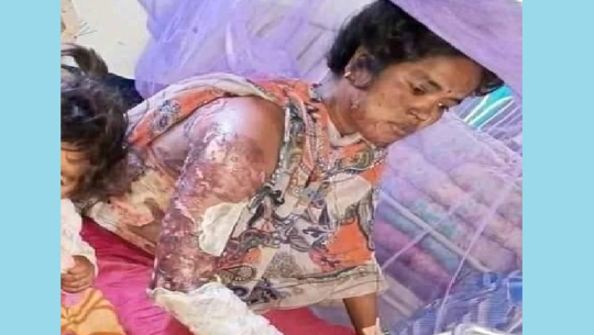 आगोले जलेकी डोटीकी महिला ल्याउन हेलिकप्टर