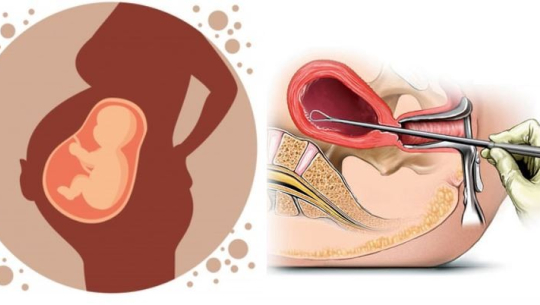 अविवाहित महिलाले २४ हप्तासम्मको गर्भपतन गराउन सक्ने सर्वोच्चको फैसला 