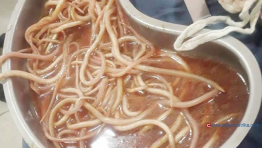 आठ वर्षीय बालकको पेटमा ७ सय ग्राम जुका