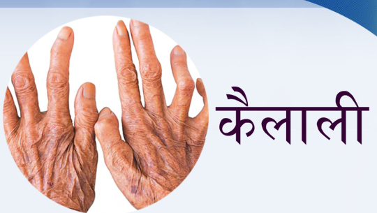 कैलाली कुष्ठ रोगको उच्च जोखिममा  