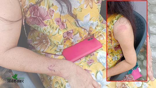 प्रहरीले हातपात गरेको कञ्चनपुरकी एक महिलाको आरोप, प्रहरी भन्छ– झुटो हो