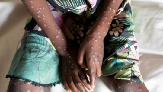 ’एमपक्स’को प्रकोप फैलिएपछि डब्लुएचओद्वारा स्वास्थ्य आपत्काल घोषणा