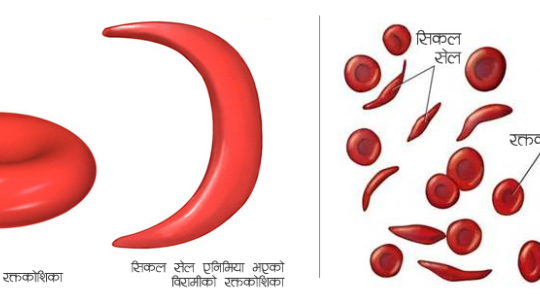 सिकलसेल एनिमियाः किन र कसरी लाग्छ यो रोग ?