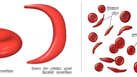 सुदूरमा थारू समुदायका १२ प्रतिशतलाई सिकलसेल, कसरी लाग्छ यो रोग?