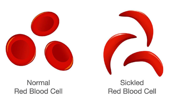 कञ्चनपुरमा ‘सिकलसेल एनिमिया’ रोगको जोखिम