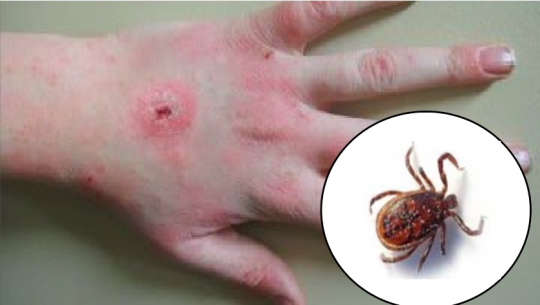 दार्चुलामा स्क्रब टाइफसका १७ जना बिरामी फेला