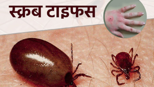 कायमै छ स्क्रब टाइफसको जोखिम, रोकथामका गर्न के गर्ने ?